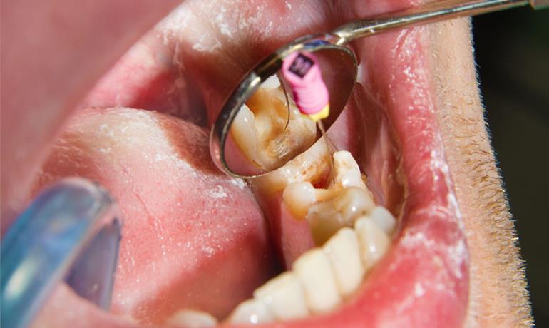 چه دلایلی موجب آسیب به عصب دندان می‌شوند؟